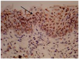 Biomarcadores P16 e Ki67: Aliados no Diagnóstico do Câncer de Colo Uterino